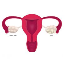 adobestock_542138636-dee-sign-uterus-web.jpg