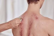 Guasha-Massage - chinesische Schabmassage